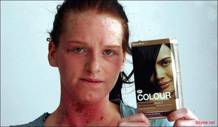 Аллергия на краску для волос (6 фотографий), photo:4