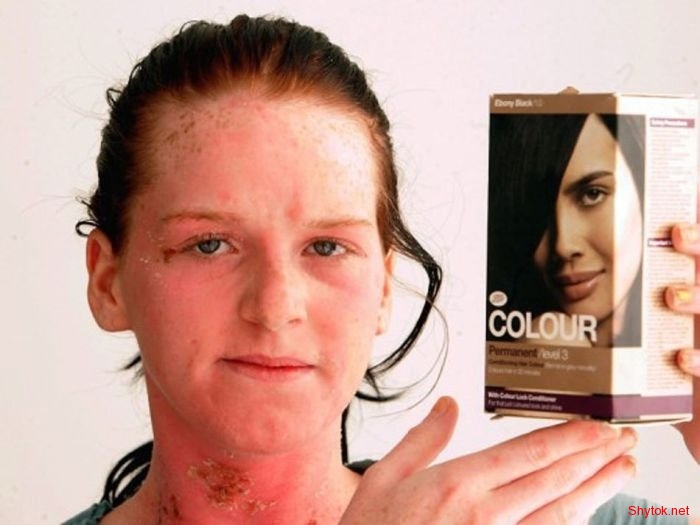 Аллергия на краску для волос (6 фотографий), photo:6